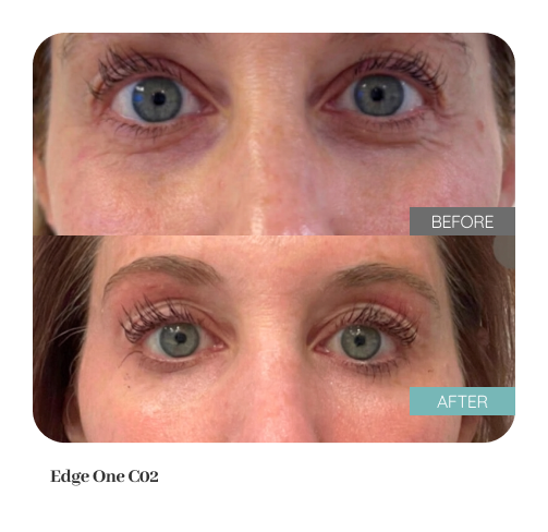 Before and after treatment result — Dr. Lanna, LC Medical Aesthetics NYC